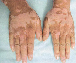 白癜风饮食要注意些什么