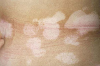 白癜风患者的饮食有什么禁忌